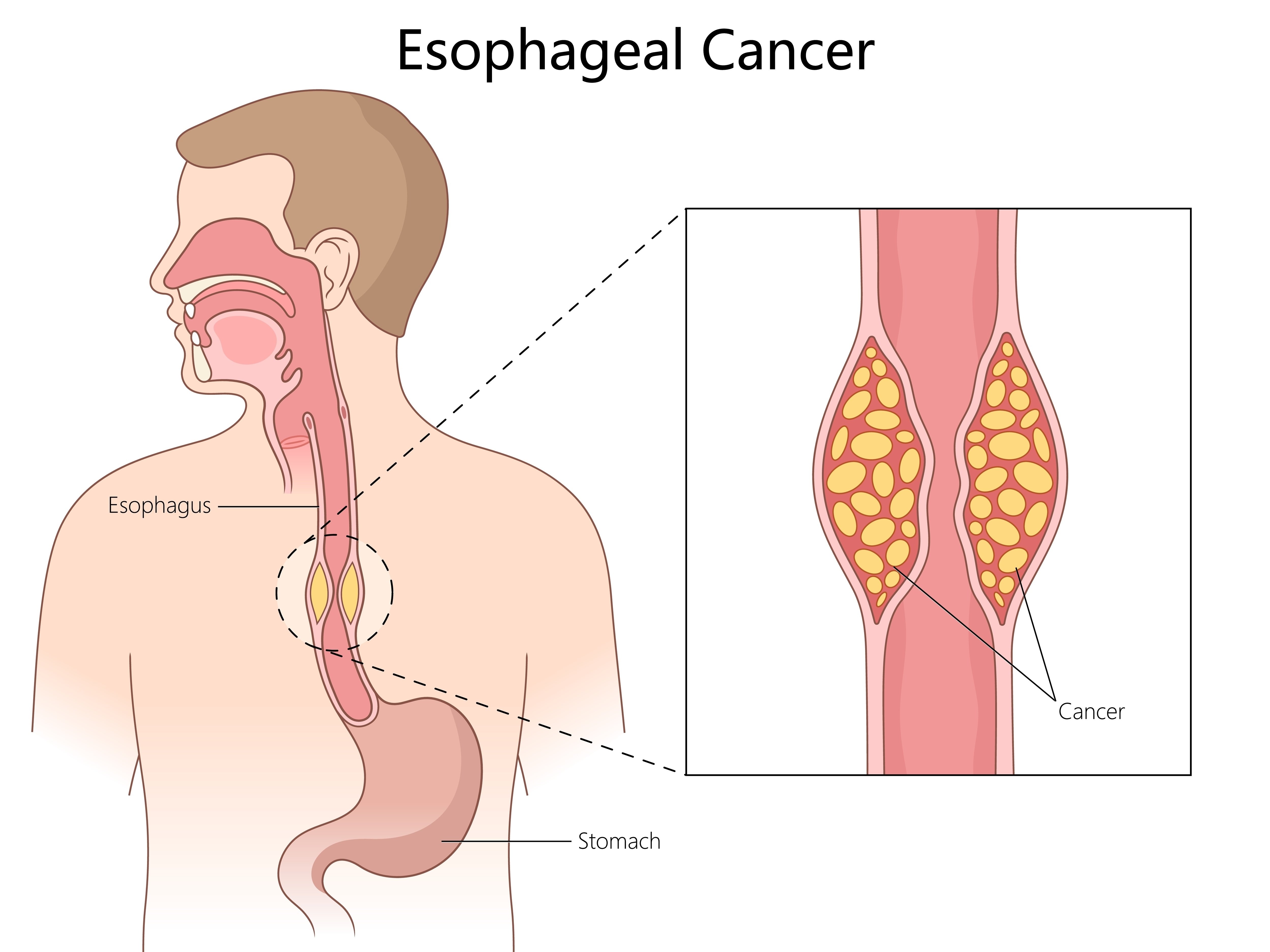 Esophageal Cancer Diagram